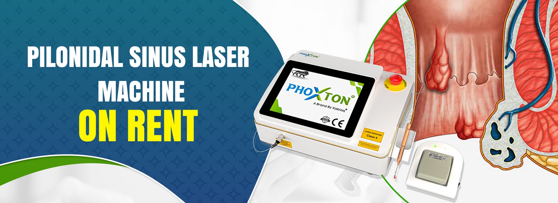 Pilonidal Sinus Laser Machine On Rent