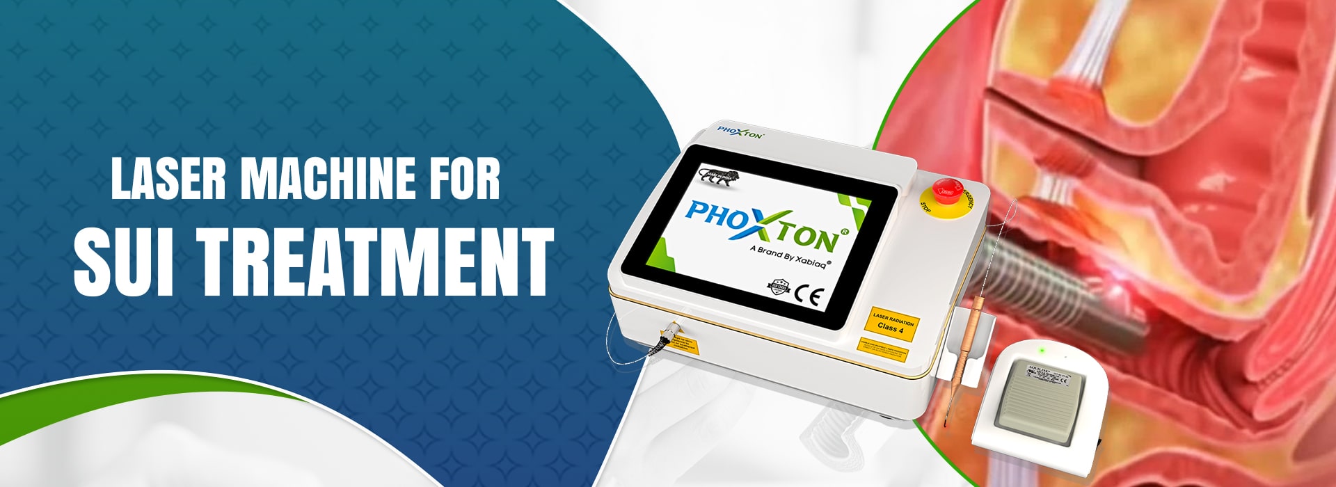 Laser Machine for SUI Treatment in Ahmedabad